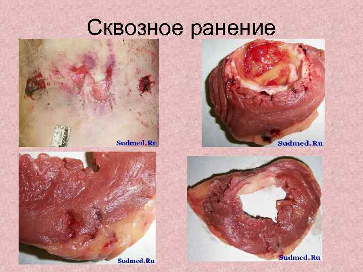 Сквозное ранение 