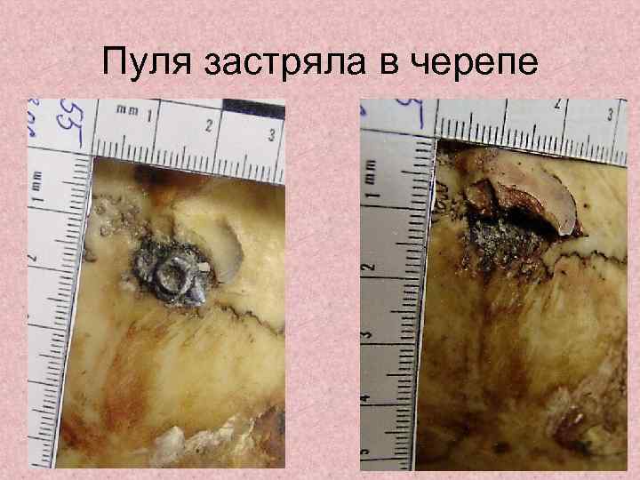 Пуля застряла в черепе 