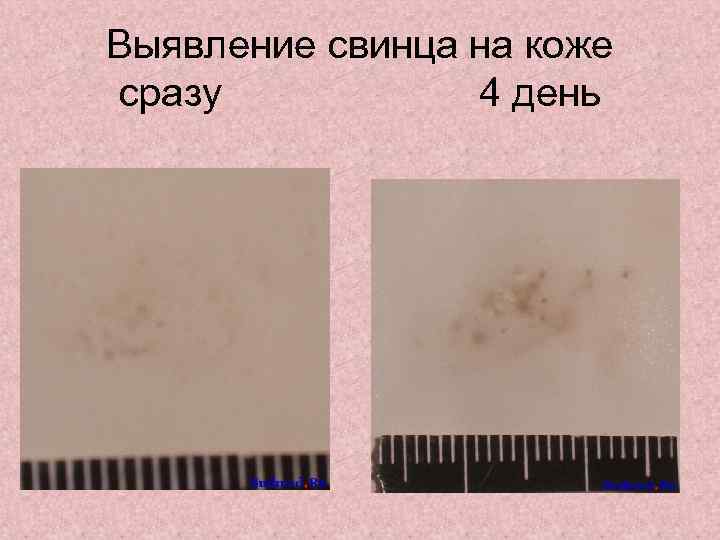 Выявление свинца на коже сразу 4 день 