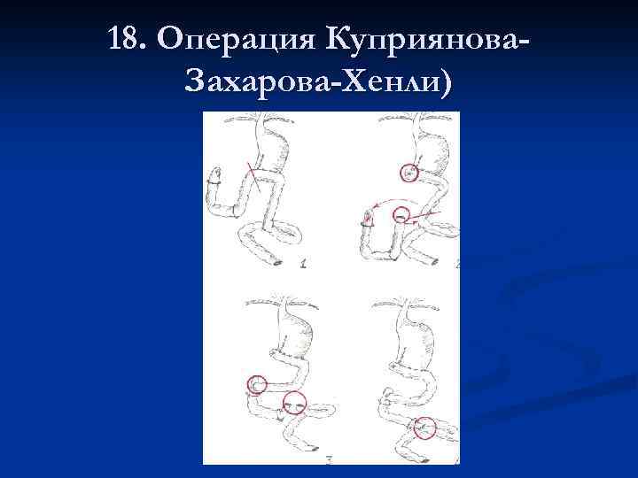 18. Операция Куприянова. Захарова-Хенли) 