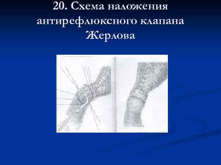 20. Схема наложения антирефлюксного клапана Жерлова 