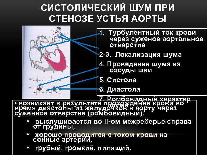 СИСТОЛИЧЕСКИЙ ШУМ ПРИ СТЕНОЗЕ УСТЬЯ АОРТЫ 1. Турбулентный ток крови через суженое аортальное отверстие