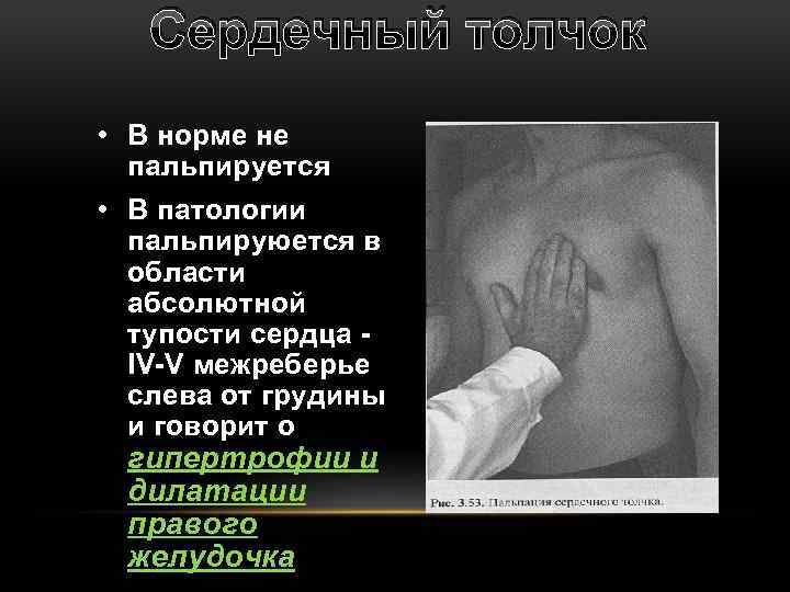 Сердечный толчок • В норме не пальпируется • В патологии пальпируюется в области абсолютной