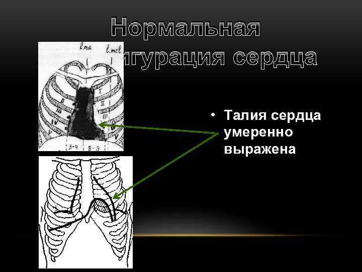 Нормальная конфигурация сердца • Талия сердца умеренно выражена 