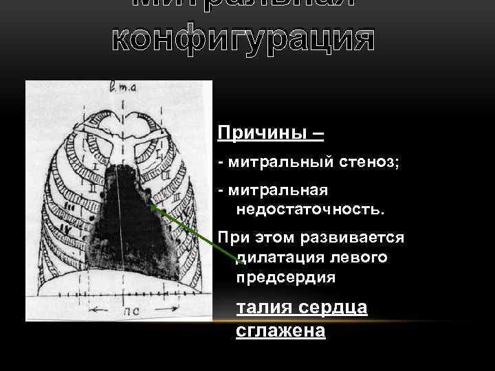 Митральная конфигурация Причины – - митральный стеноз; - митральная недостаточность. При этом развивается дилатация