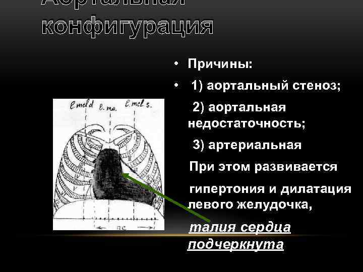 Аортальная конфигурация • Причины: • 1) аортальный стеноз; 2) аортальная недостаточность; 3) артериальная При