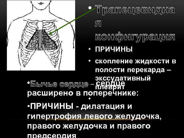  • Трапецевидна я конфигурация • ПРИЧИНЫ • скопление жидкости в полости перекарда –