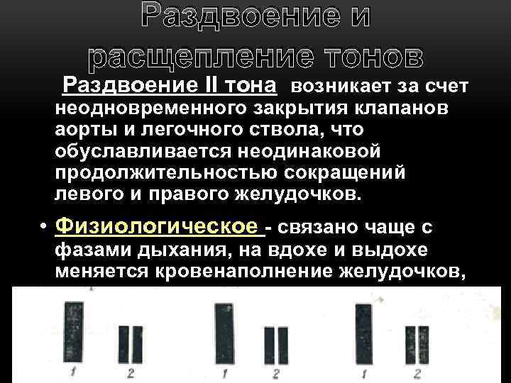 Раздвоение и расщепление тонов Раздвоение II тона возникает за счет неодновременного закрытия клапанов аорты