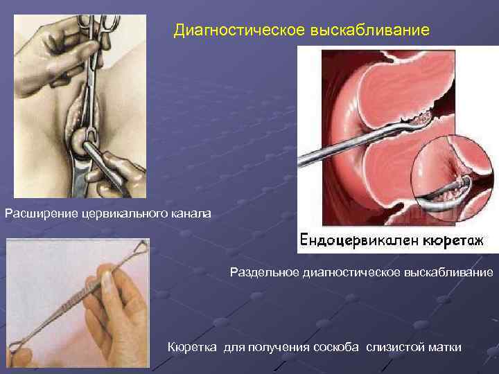 Диагностическое выскабливание Расширение цервикального канала Раздельное диагностическое выскабливание Кюретка для получения соскоба слизистой матки