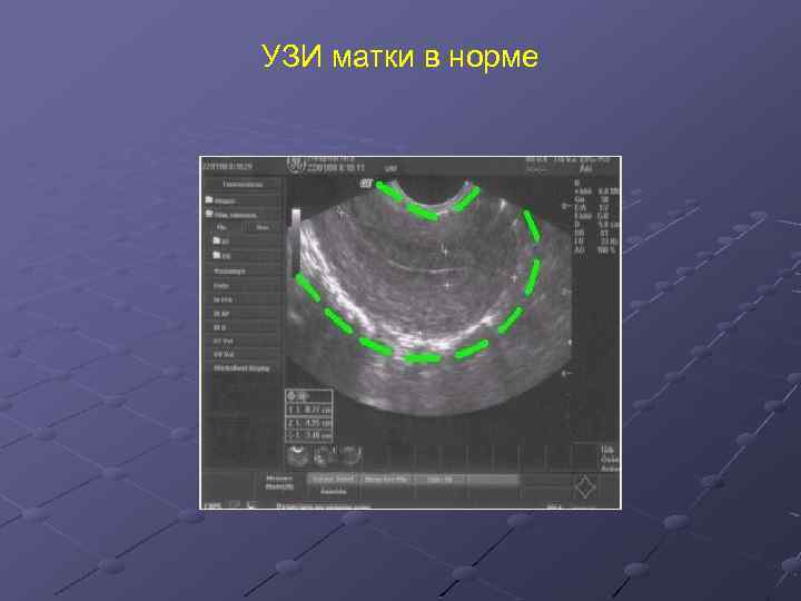 Размеры матки в норме