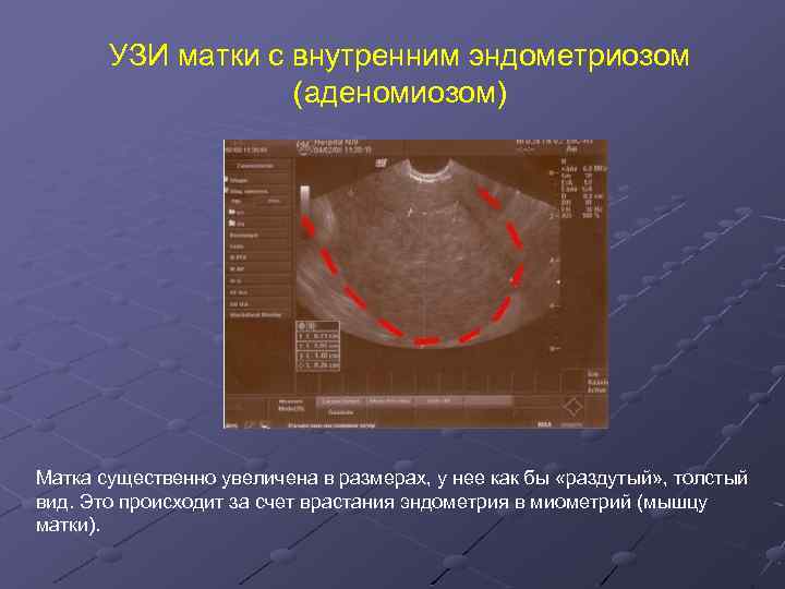 Эндометрий матки размер. УЗИ критерии внутреннего эндометриоза. Внутренний эндометриоз на УЗИ.