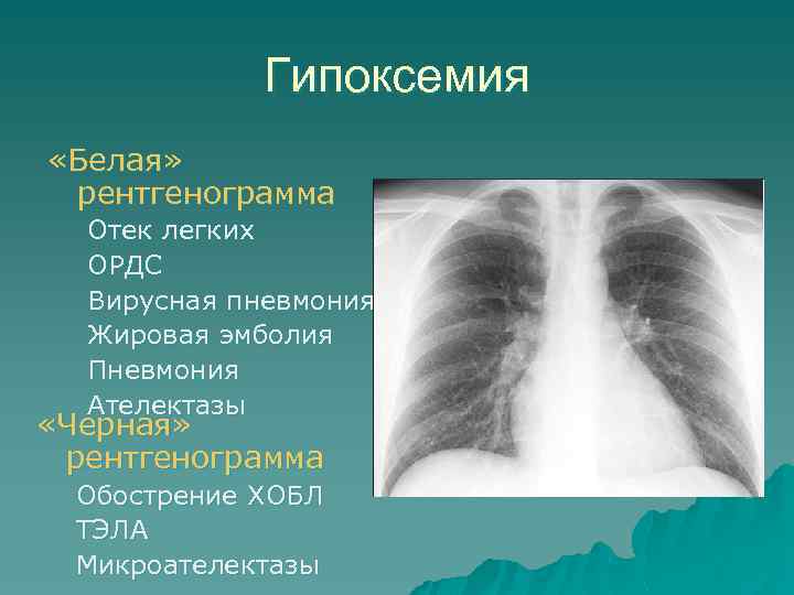 Гипоксемия «Белая» рентгенограмма Отек легких ОРДС Вирусная пневмония Жировая эмболия Пневмония Ателектазы «Черная» рентгенограмма