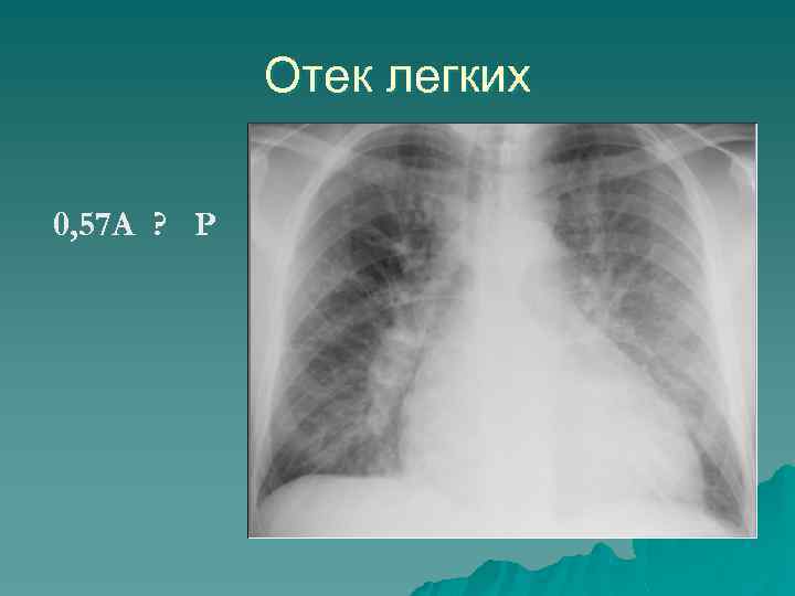 Отек легких 0, 57 A ? P 