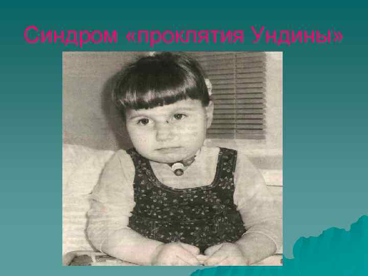 Синдром «проклятия Ундины» 