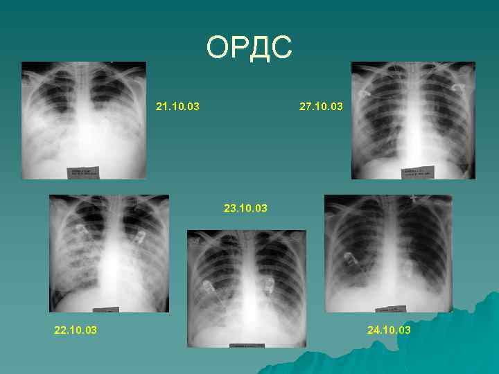 ОРДС 21. 10. 03 27. 10. 03 23. 10. 03 22. 10. 03 24.