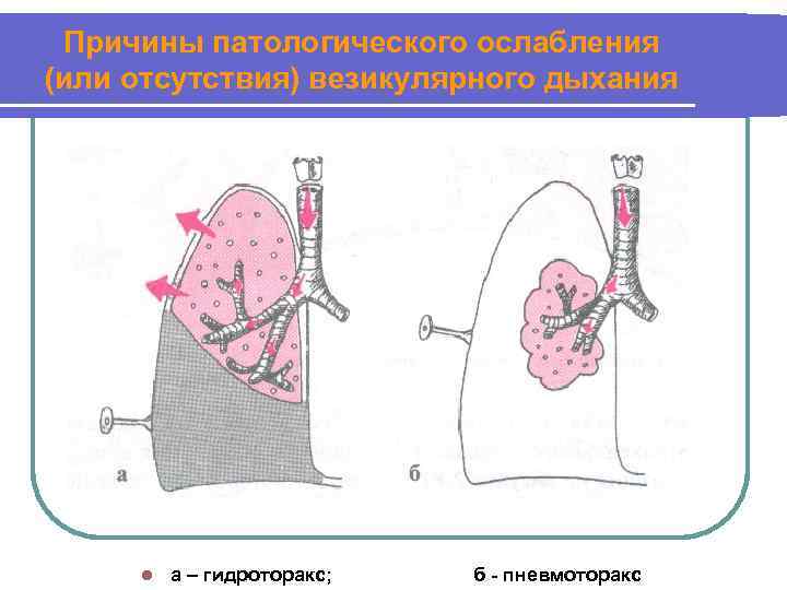 Причины патологического ослабления (или отсутствия) везикулярного дыхания l а – гидроторакс; б - пневмоторакс