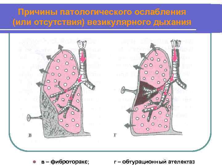 Причины патологического ослабления (или отсутствия) везикулярного дыхания l в – фиброторакс; г – обтурационный