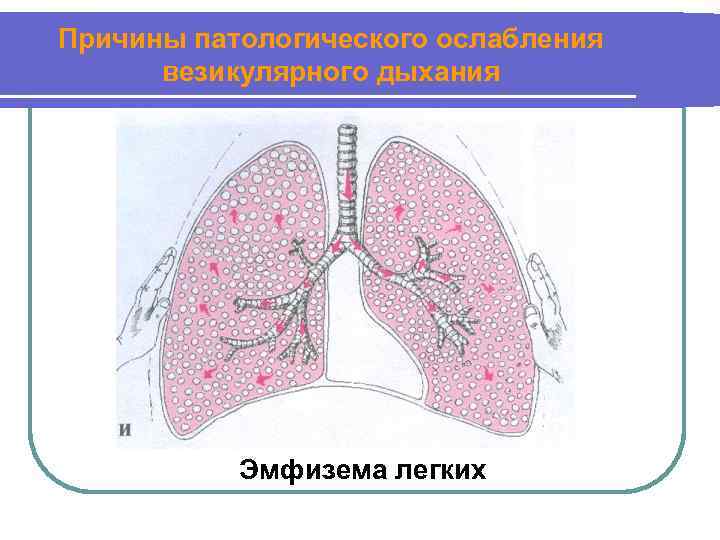 Причины патологического ослабления везикулярного дыхания Эмфизема легких 