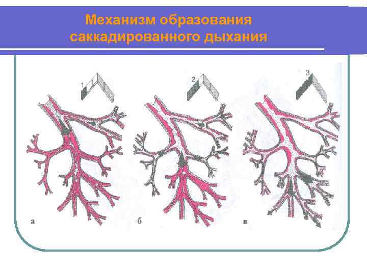 Механизм образования саккадированного дыхания 