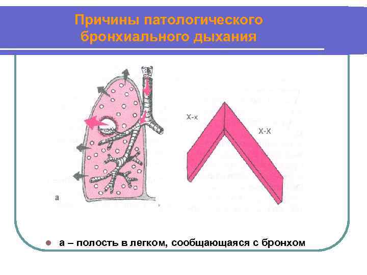 Причины патологического бронхиального дыхания l а – полость в легком, сообщающаяся с бронхом 