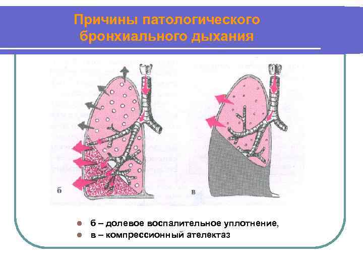 Причины патологического бронхиального дыхания б – долевое воспалительное уплотнение, l в – компрессионный ателектаз