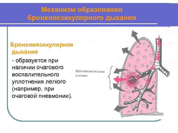 Механизм образования бронховезикулярного дыхания Бронховезикулярное дыхание - образуется при наличии очагового воспалительного уплотнения легкого