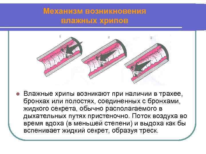 Механизм возникновения влажных хрипов l Влажные хрипы возникают при наличии в трахее, бронхах или