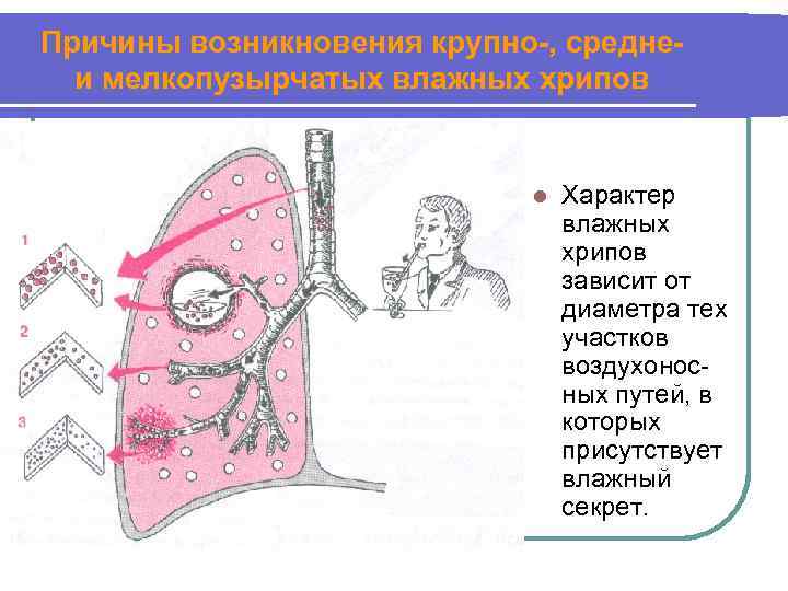 Причины возникновения крупно-, среднеи мелкопузырчатых влажных хрипов l Характер влажных хрипов зависит от диаметра