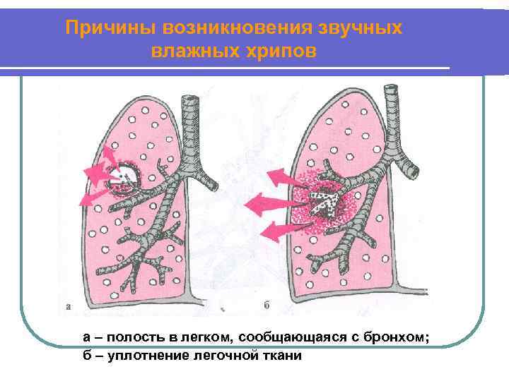 Полости в бронхах