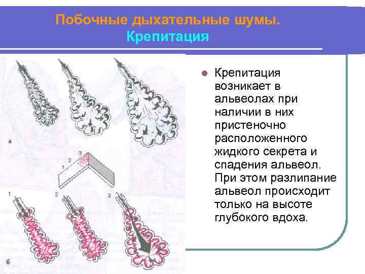 Побочные дыхательные шумы. Крепитация l Крепитация возникает в альвеолах при наличии в них пристеночно