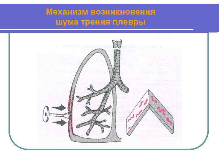 Механизм возникновения шума трения плевры 