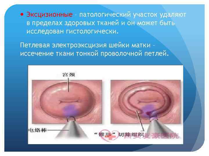  Эксцизионные – патологический участок удаляют в пределах здоровых тканей и он может быть