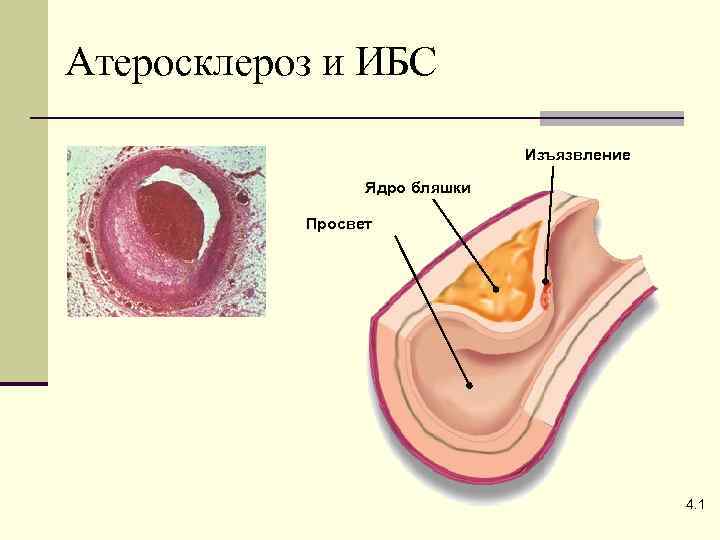 Атеросклероз и ИБС Изъязвление Ядро бляшки Просвет 4. 1 