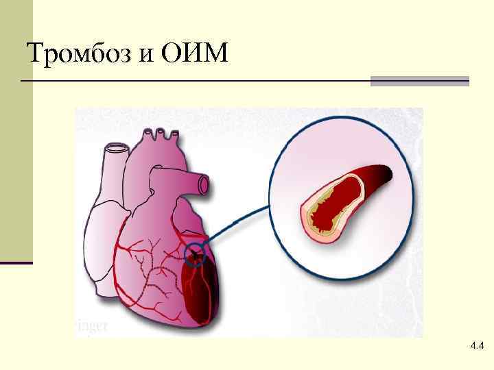 Тромбоз и ОИМ 4. 4 