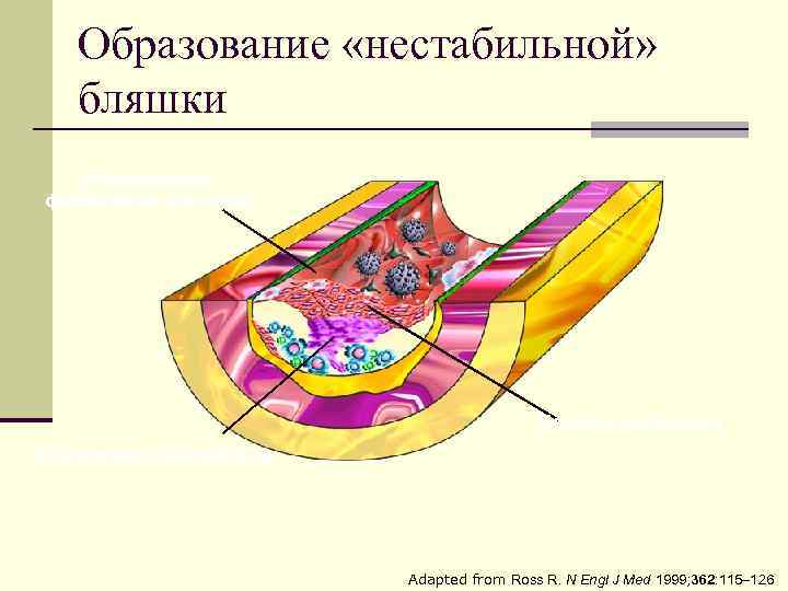 Образование «нестабильной» бляшки Образование фиброзной капсулы Некроз покрышки Скопление макрофагов Adapted from Ross R.