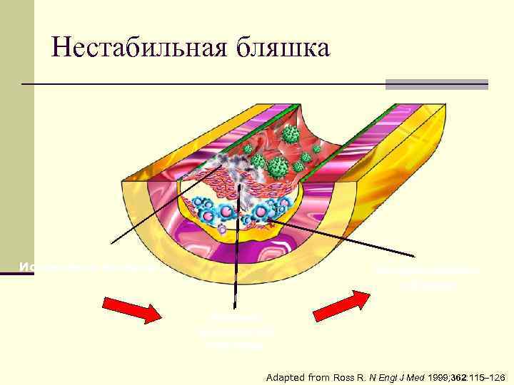 Нестабильная бляшка Истончение капсулы Кровоизлияние в бляшку Разрыв фиброзной капсулы Adapted from Ross R.