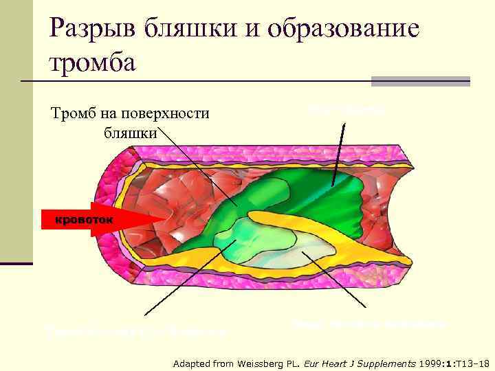 Разрыв бляшки и образование тромба Тромб на поверхности бляшки Рост тромба кровоток Тромбоз внутри