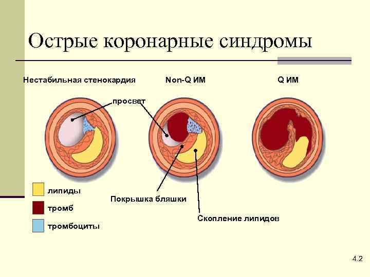 Окс нестабильная стенокардия