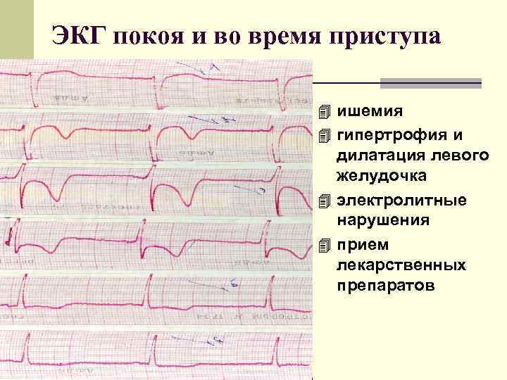 Изменение передней стенки левого желудочка. Изменения на ЭКГ при ишемической болезни сердца. Субэндокардиальная ишемия на ЭКГ. Ишемия миокарда на ЭКГ. Ишемия задней стенки сердца на ЭКГ.
