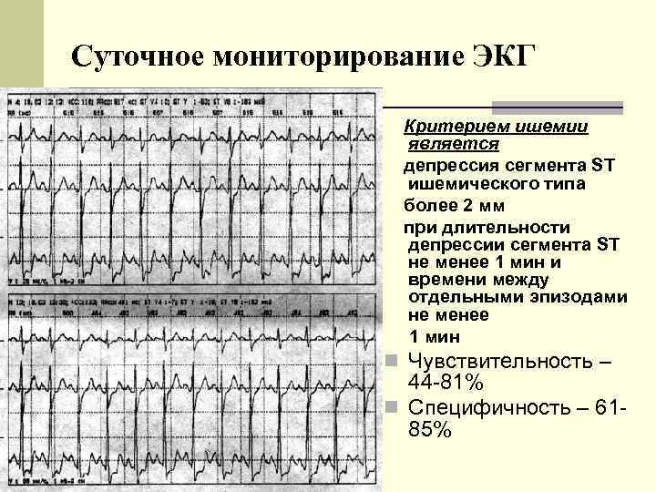 Экг депрессия сегмента