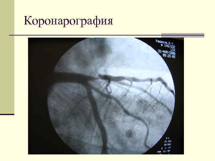 Коронарография 