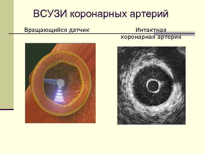 Узи коронарных артерий. Внутрисосудистое УЗИ коронарных артерий. ВСУЗИ коронарных. Внутрисосудистый ультразвук коронарных артерий. Внутрисосудистое ультразвуковое исследование.