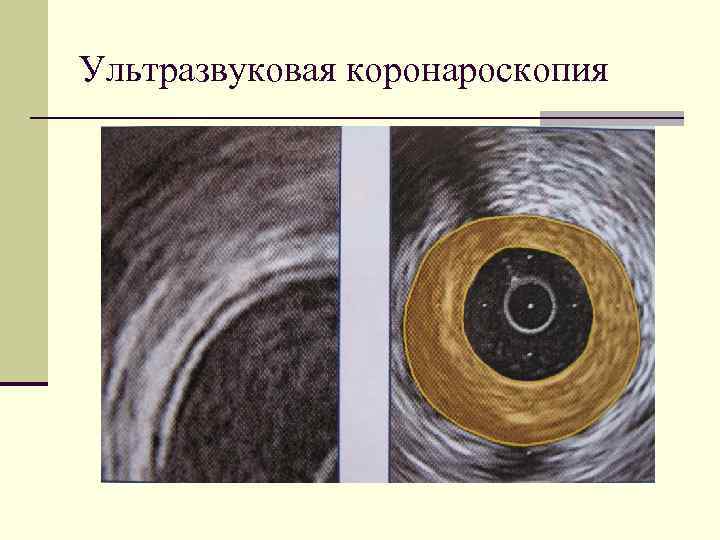 Ультразвуковая коронароскопия 