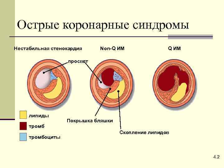 Острые коронарные синдромы Нестабильная стенокардия Non-Q ИМ просвет липиды Покрышка бляшки тромбоциты Скопление липидов