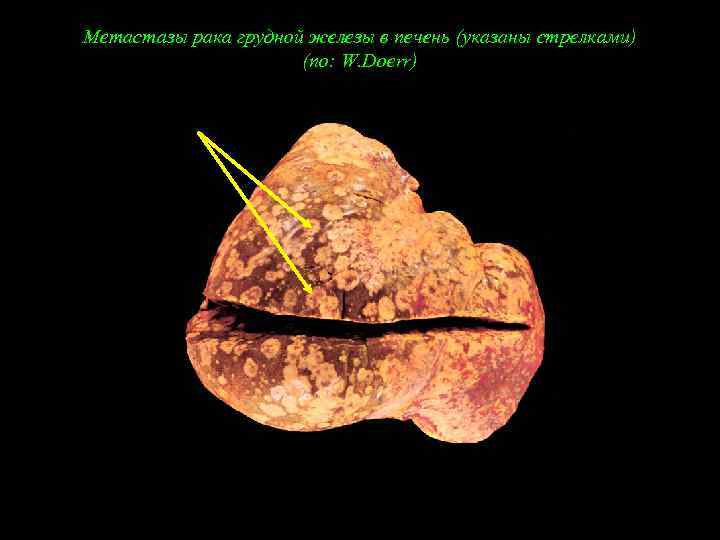Метастазы рака грудной железы в печень (указаны стрелками) (по: W. Doerr) 