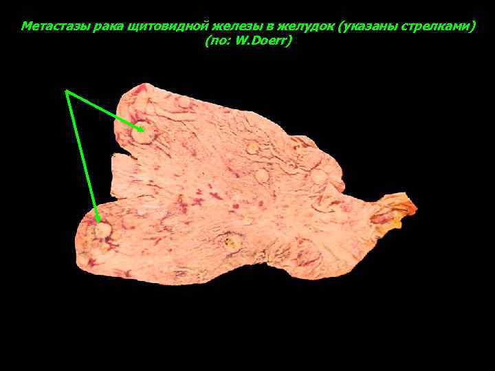 Метастазы рака щитовидной железы в желудок (указаны стрелками) (по: W. Doerr) 