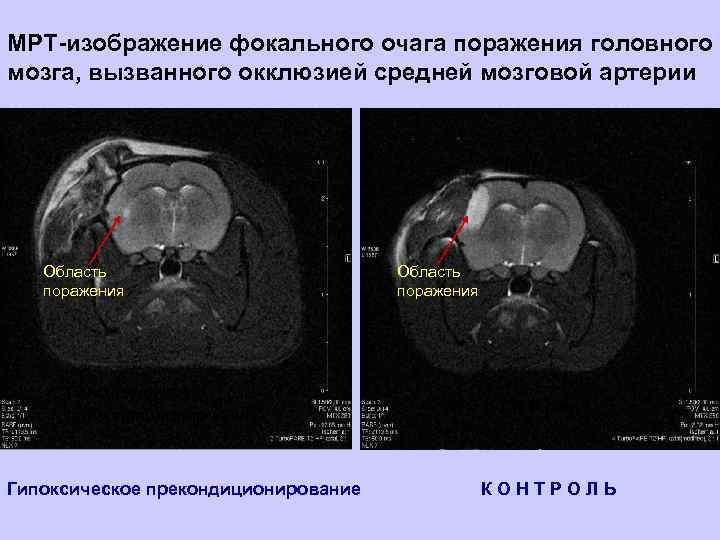 МРТ-изображение фокального очага поражения головного мозга, вызванного окклюзией средней мозговой артерии Область поражения Гипоксическое