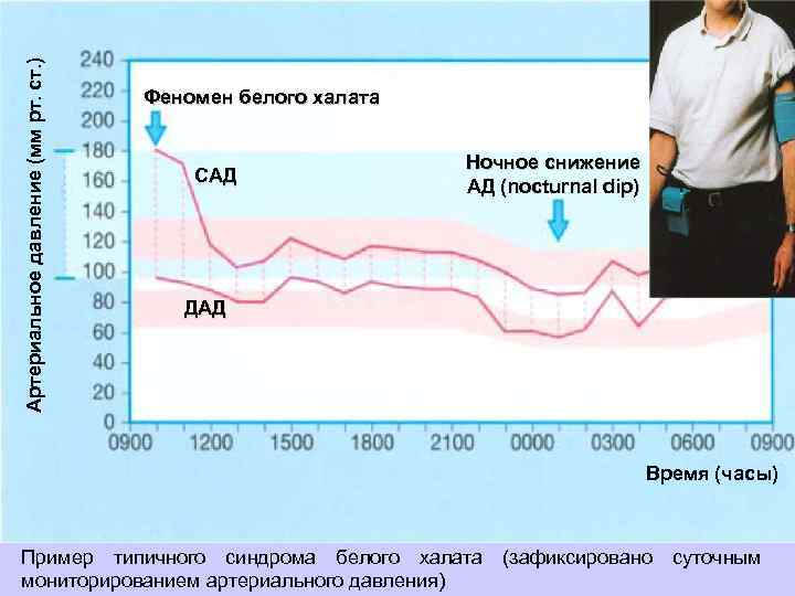 Артериальное давление (мм рт. ст. ) Феномен белого халата САД Ночное снижение АД (nocturnal