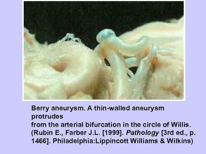 Berry aneurysm. A thin-walled aneurysm protrudes from the arterial bifurcation in the circle of