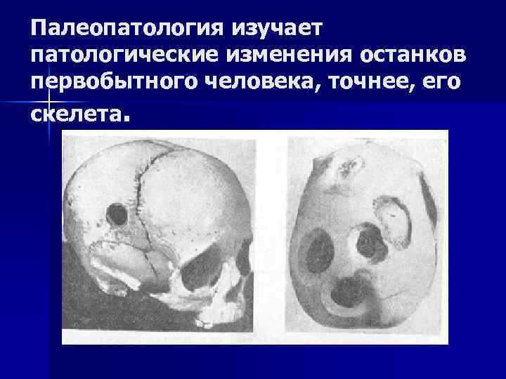 Палеопатология изучает патологические изменения останков первобытного человека, точнее, его скелета. 